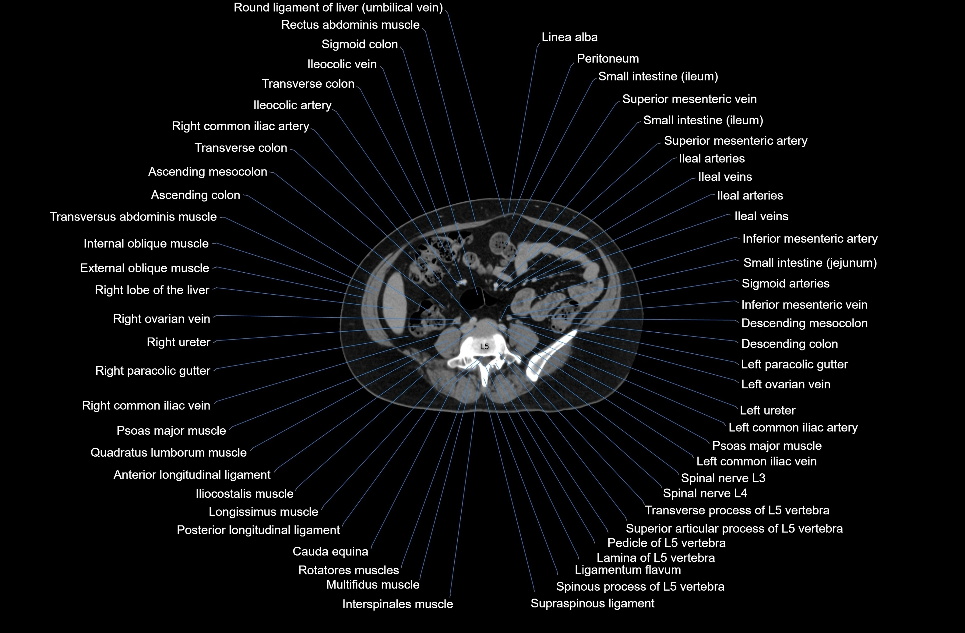 CT Abdomen axial cross sectional anatomy labelled radiology image-00057.webp